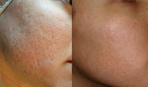 Гиперпигментация кожи лица после пилинга