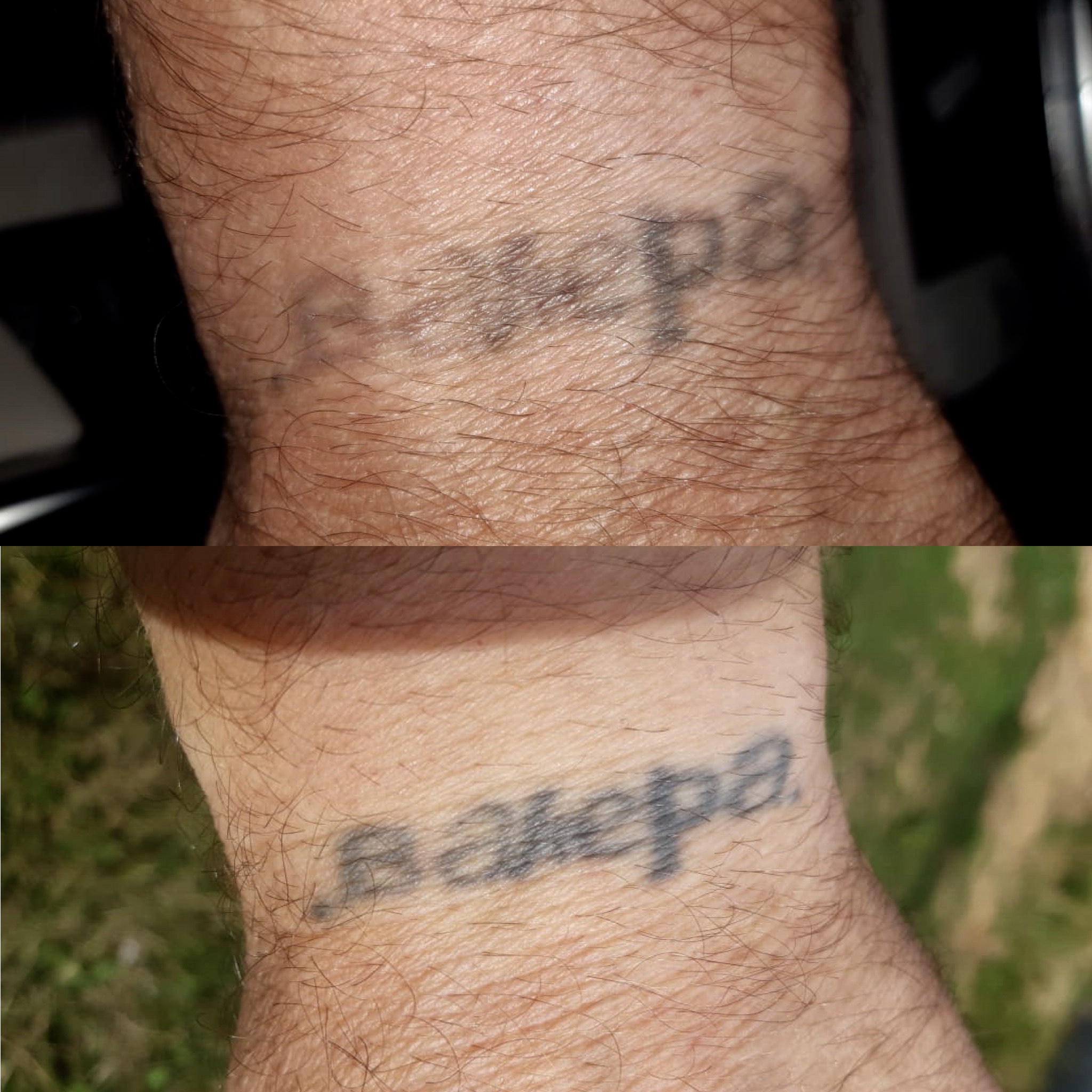 Остается ли шрам после удаления татуировки лазером?